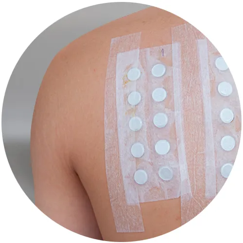 Rows of patch test discs taped to a patient's upper back