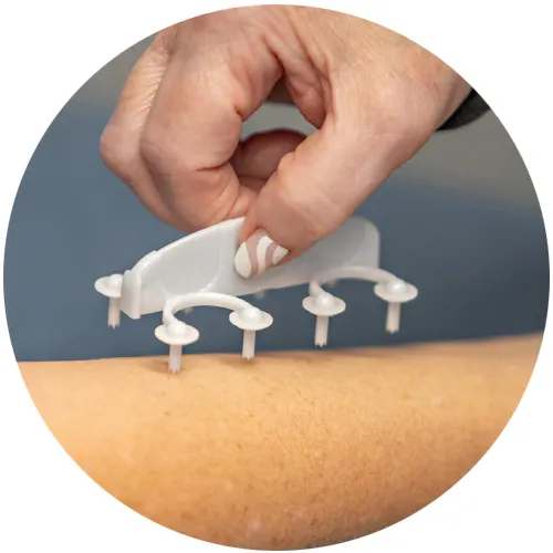 Allergist pressing a multi-prong skin prick testing device onto a patient's forearm