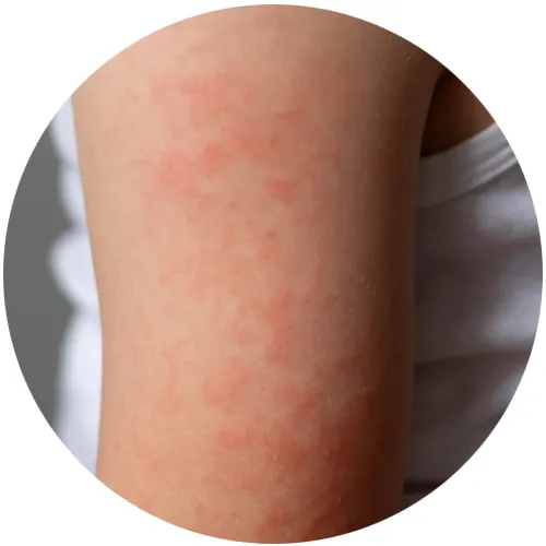Red, blotchy eczema rash on a child's upper arm